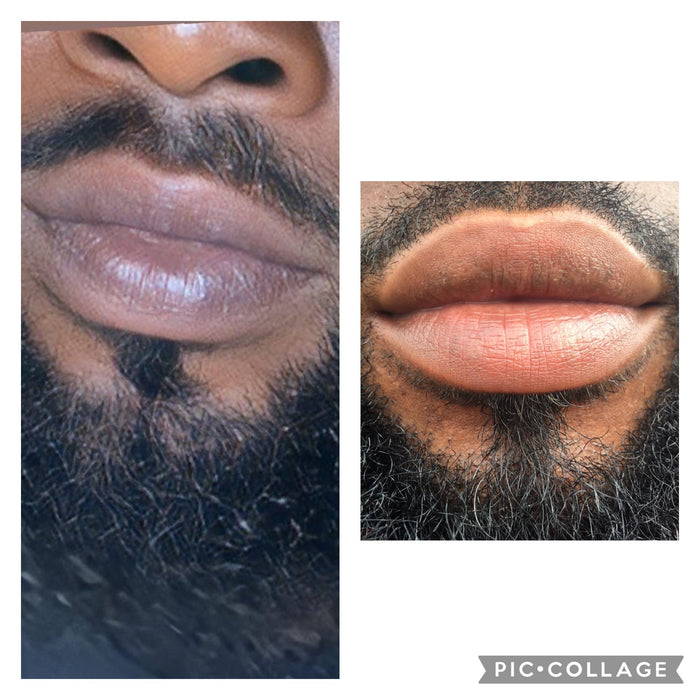 FACE AND LIP PEEL
